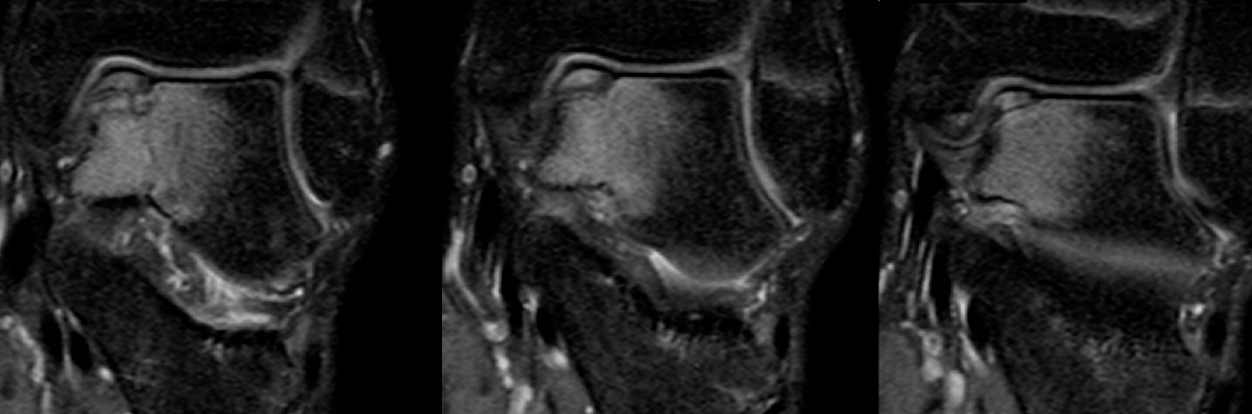 Figure 4 for case Osteochondral lesion talar dome